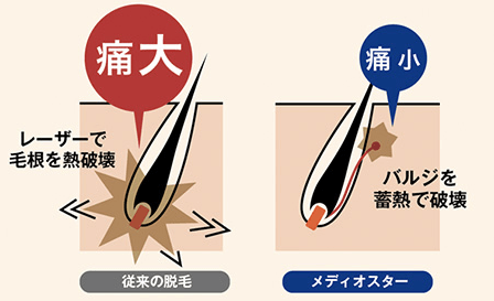 バルジ領域を破壊